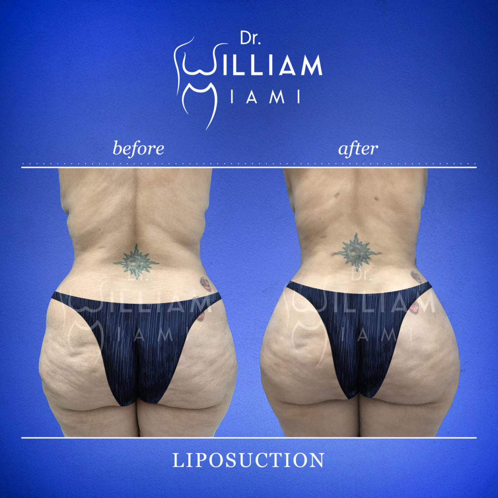 Ogee Lipo | Liposuction Technique | Best Liposuction Results