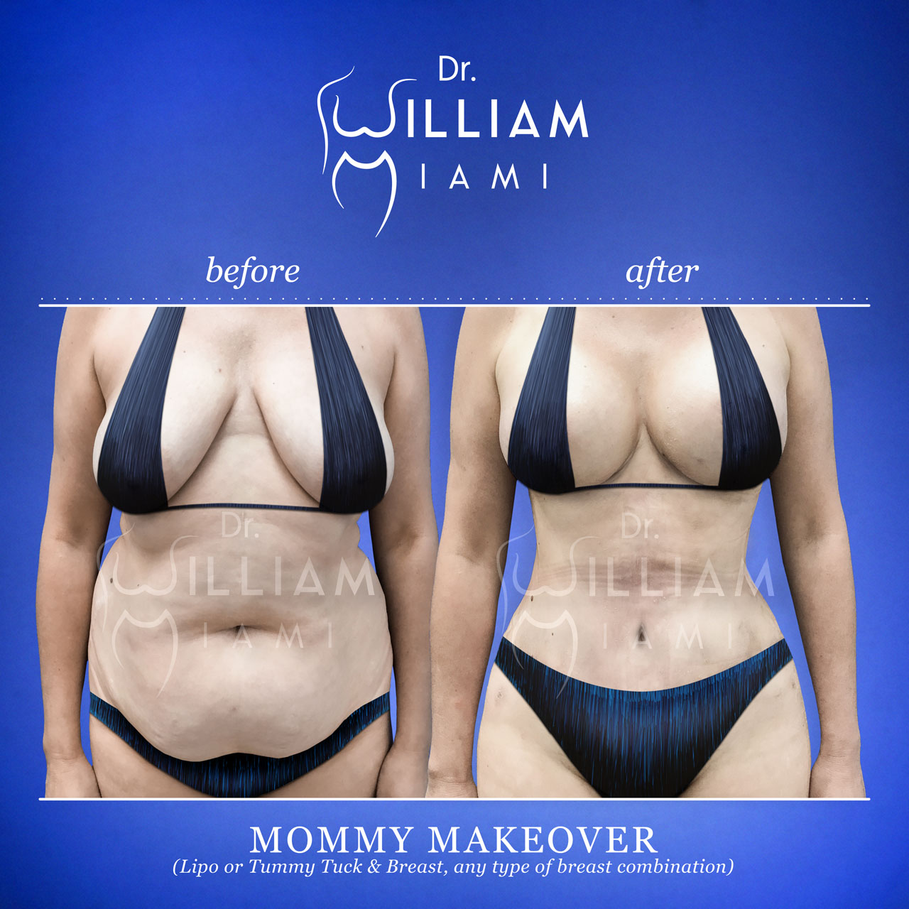 How Much Does Tummy Tuck Surgery Cost? Williams Center