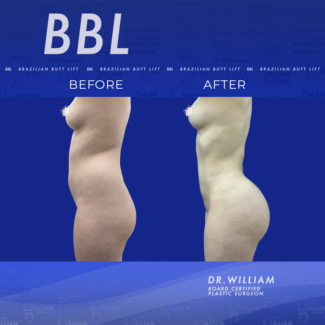 Miami Brazilian Butt Lift  BBL Procedures in Miami, FL