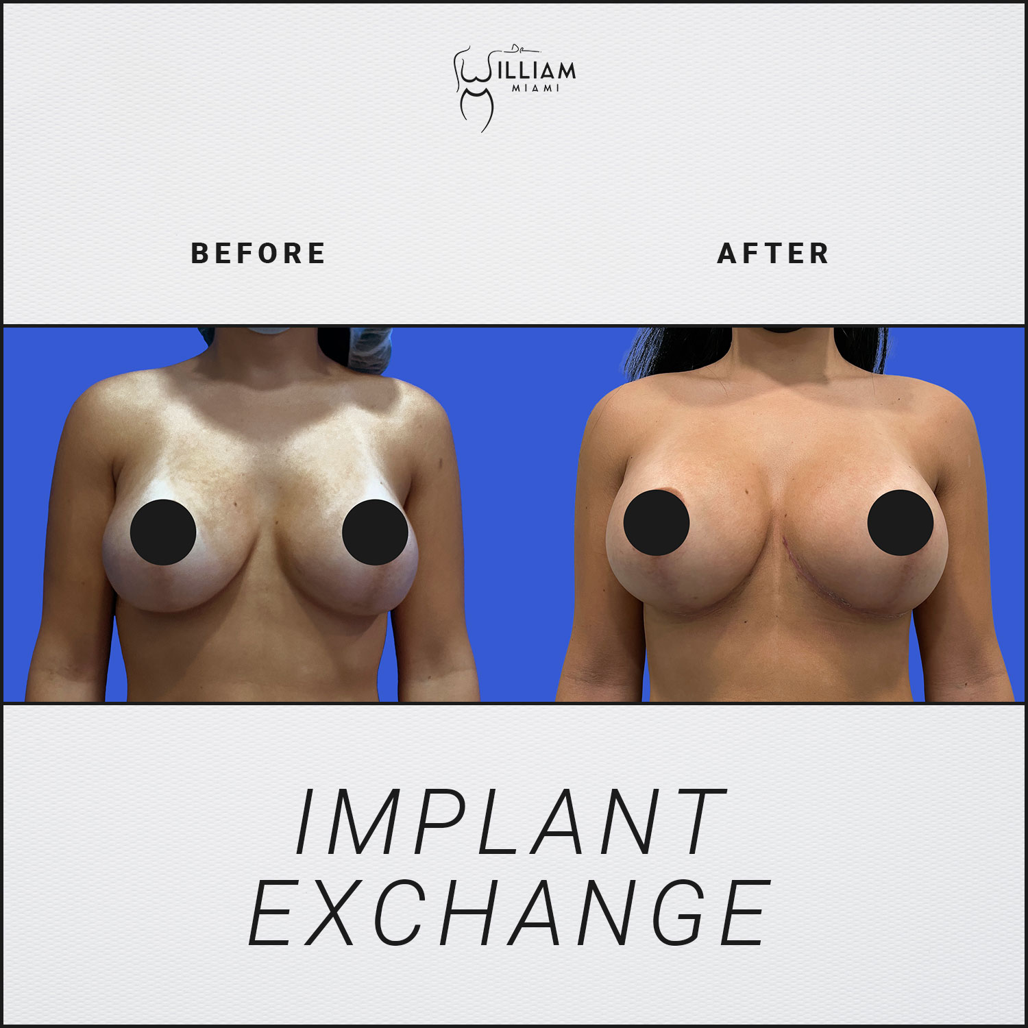 breast impants