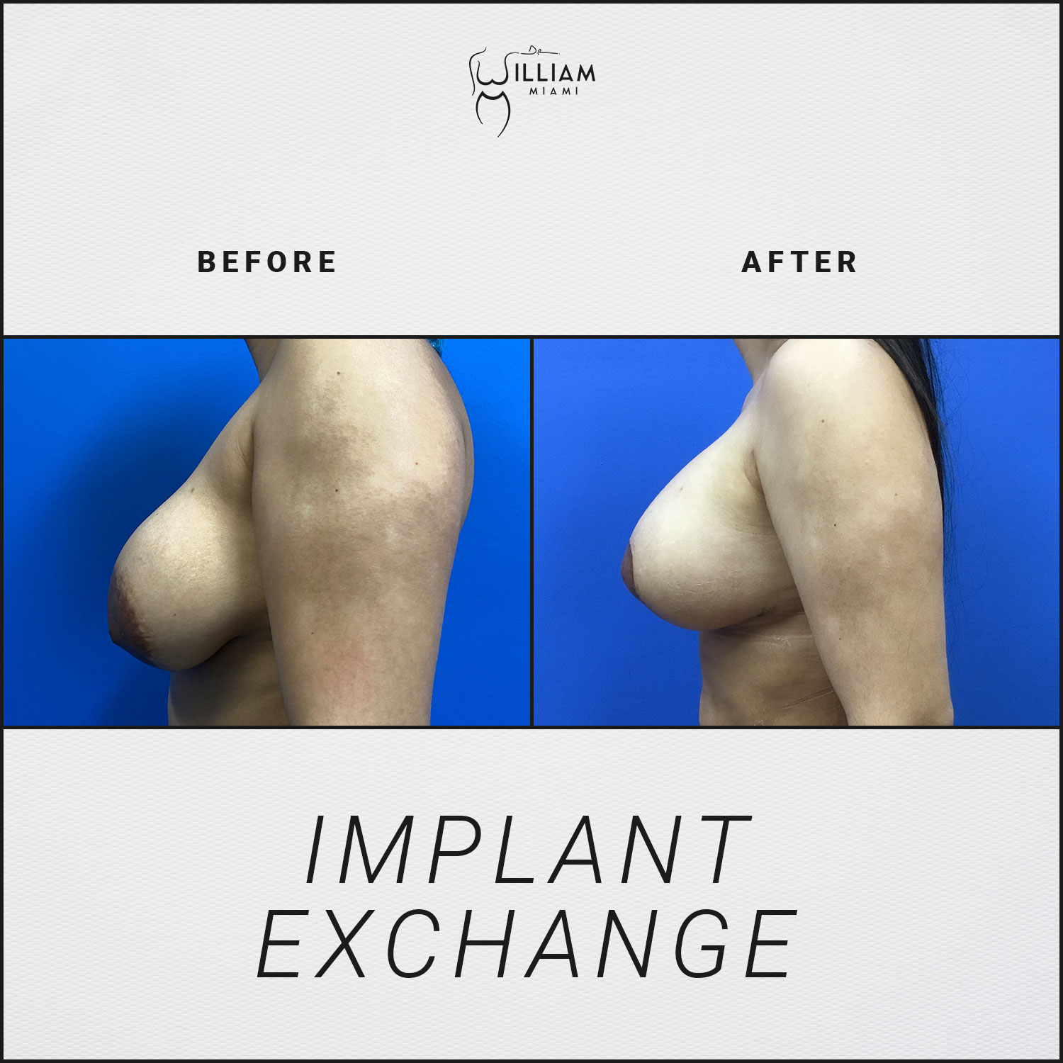 Implant Exchange