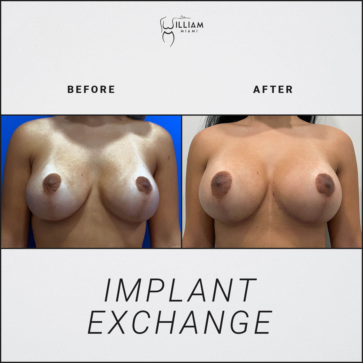 Implant Exchange