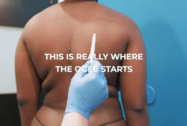 back lipo