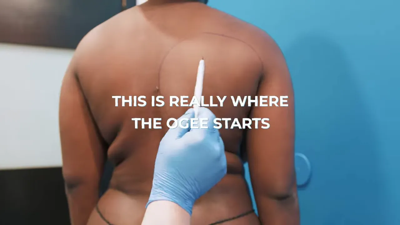 back lipo